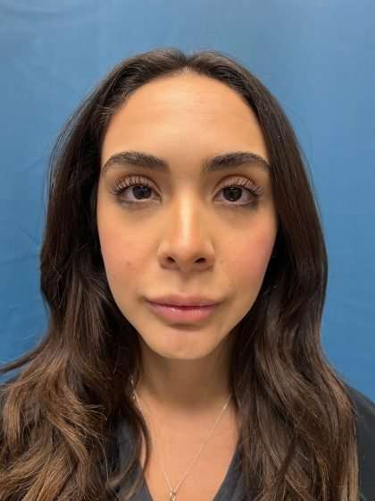 Lip Lift Before & After Patient #1279