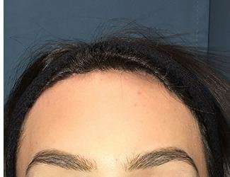 Forehead Reduction Before & After Patient #1364