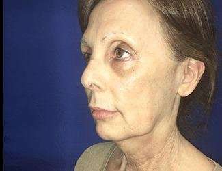 Facial Implants Before & After Patient #1392