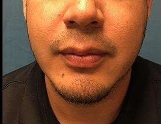 Facial Implants Before & After Patient #1403