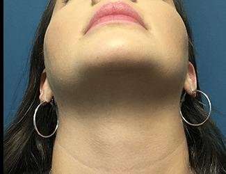 Facial Implants Before & After Patient #1416
