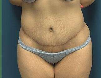 Tummy Tuck Before & After Patient #369