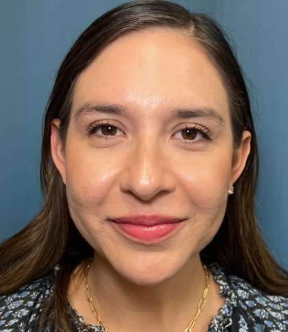 Facial Implants Before & After Patient #1486