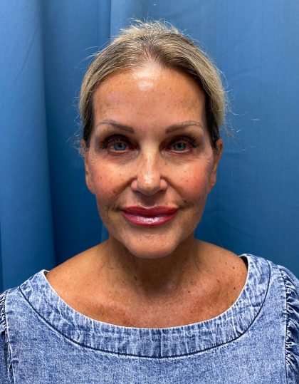 Facelift And Necklift Before & After Patient #1497