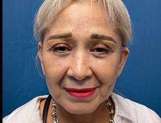 Facelift And Necklift Before & After Patient #1531