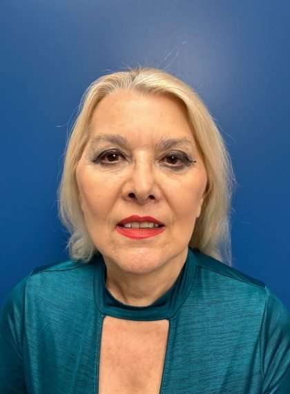 Facelift And Necklift Before & After Patient #1542