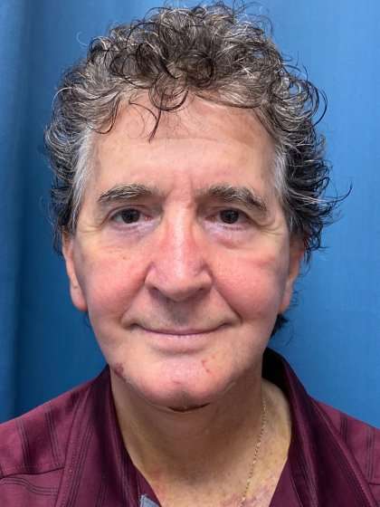 Facelift And Necklift Before & After Patient #1560