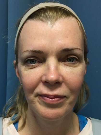 Facelift And Necklift Before & After Patient #1582
