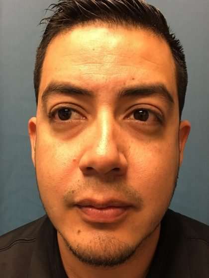 Chin Implant Before & After Patient #1604