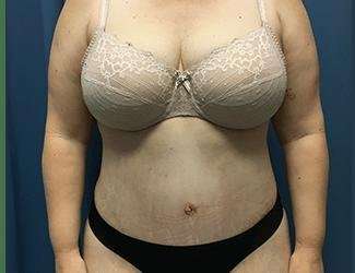 Tummy Tuck Before & After Patient #380