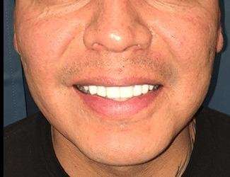 Buccal Fat Removal Before & After Patient #1656