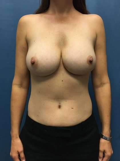 Breast Revision Before & After Patient #1716