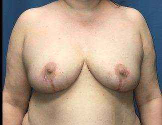 Breast Reduction Before & After Patient #1727