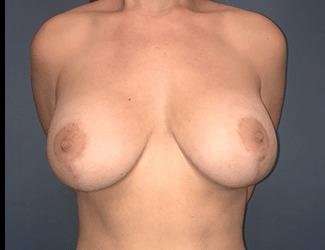 Breast Reduction Before & After Patient #1749