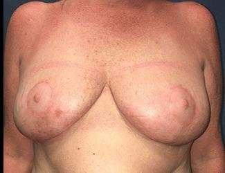Breast Reduction Before & After Patient #1760