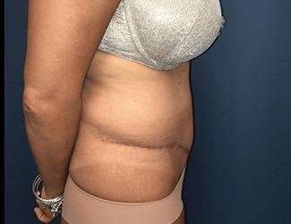 Tummy Tuck Before & After Patient #395