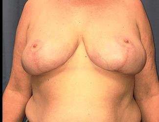 Breast Reduction Before & After Patient #1771