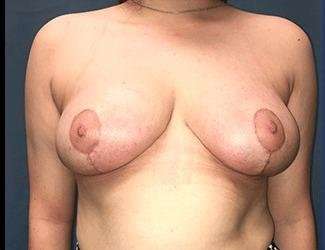 Breast Reduction Before & After Patient #1793