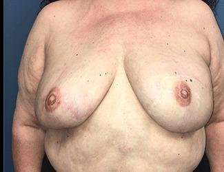 Breast Reduction Before & After Patient #1815
