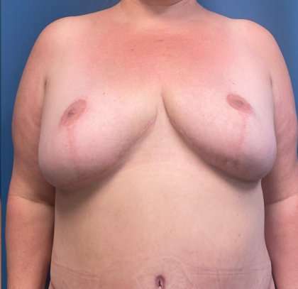Breast Lift Before & After Patient #1872