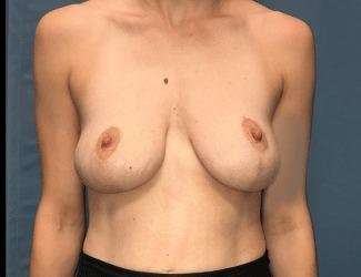 Breast Lift Before & After Patient #1923