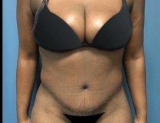 Tummy Tuck Before & After Patient #528