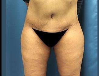 Lower Body Lift Before & After Patient #1047