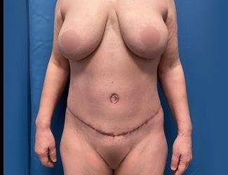 Lower Body Lift Before & After Patient #1094