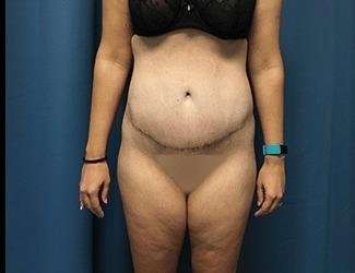 Lower Body Lift Before & After Patient #1114