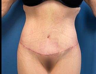 Lower Body Lift Before & After Patient #1127