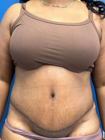 Lower Body Lift Before & After Patient #1154
