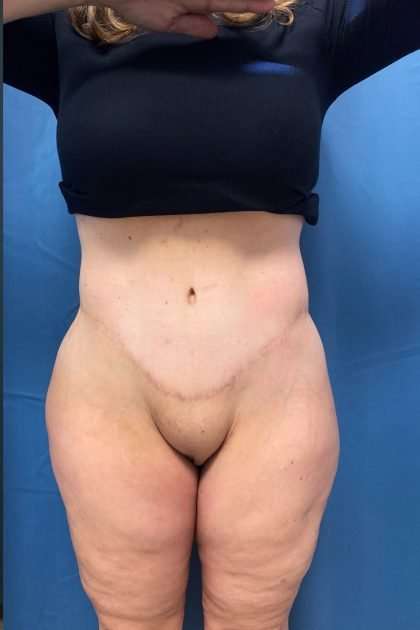 Lower Body Lift Before & After Patient #1174