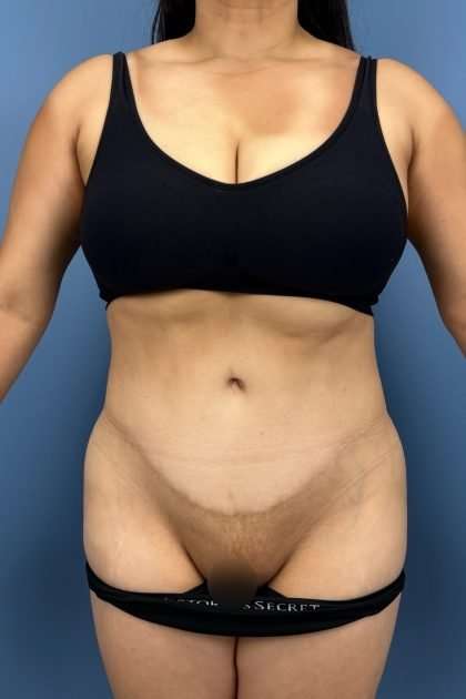 Lower Body Lift Before & After Patient #1213