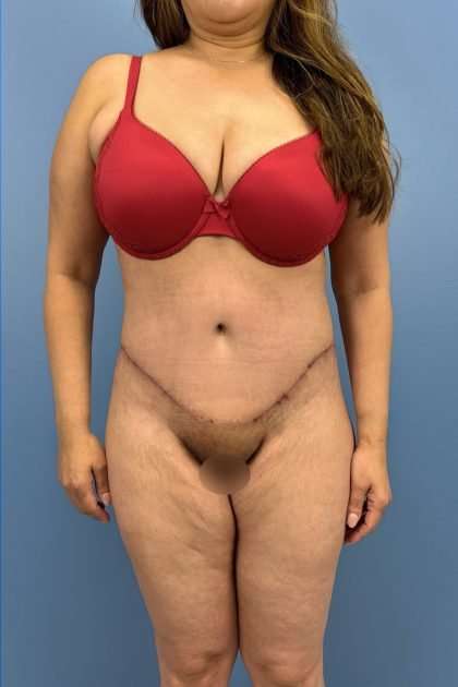 Lower Body Lift Before & After Patient #1226