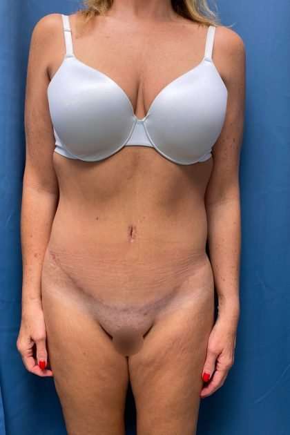 Lower Body Lift Before & After Patient #1239