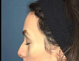 Forehead Reduction Before & After Patient #1364
