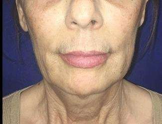 Facial Implants Before & After Patient #1392
