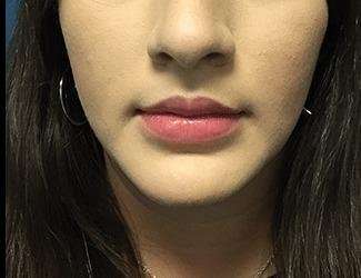 Facial Implants Before & After Patient #1416