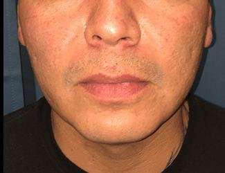 Buccal Fat Removal Before & After Patient #1656