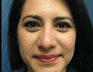 Rhinoplasty Before & After Patient #667