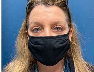Blepharoplasty Before & After Patient #2308