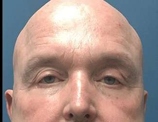 Blepharoplasty Before & After Patient #2328