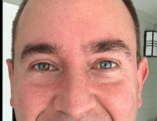 Blepharoplasty Before & After Patient #2352
