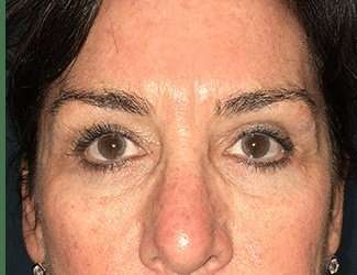 Blepharoplasty Before & After Patient #2368