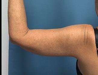 Arm Lift Before & After Patient #2461