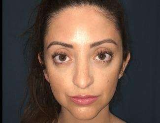 Rhinoplasty Before & After Patient #680