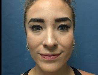Rhinoplasty Before & After Patient #706