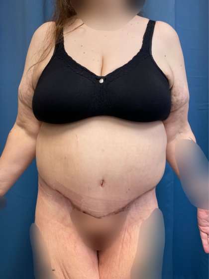 Lower Body Lift Before & After Patient #1021