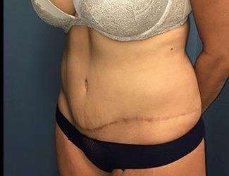 Tummy Tuck Before & After Patient #395