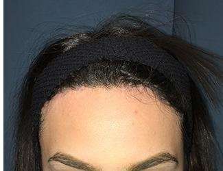 Forehead Reduction Before & After Patient #1364